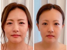 ベリンダ(belinda)/別人級小顔コルギbefore→after