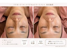 クリーン(clean)/フェイシャル　ビフォーアフター