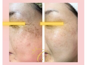 コトハ(cottha)の写真/【シミ改善コース】メイクで隠さない!気になる箇所をピンポイントで撃退!茶褐色やくすみのないお肌作り☆