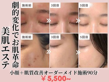 リッツ(RITZ)/【小顔矯正＋肌質改善】症例写真