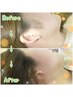 【Wax＆光脱毛】VIO+もみあげset★Wax脱毛に光脱毛をプラス★パック&角質ケア