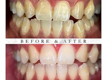 ホワイトニングセルフホワイトニング渋谷駅セルフホワイトニング