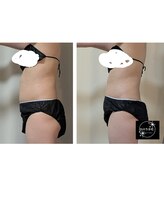 ひぺりかむ/【脂肪冷却】1回×ハンド3回