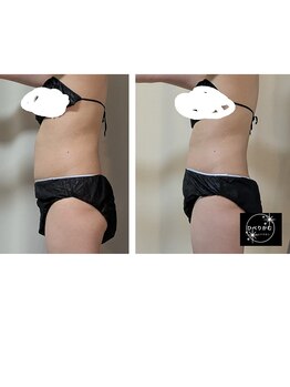 ひぺりかむ/【脂肪冷却】1回×ハンド3回