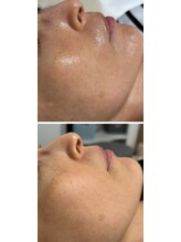 アロラヴィ(AroRavi)/肌質改善プログラム