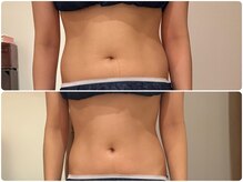 ビーグレイス(Vigrace)/ハイパーナイフEX /シェイプ