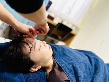 エマーマ(Emmama)/頭や顔にも鍼をします!