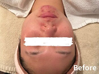 ダイヤモンド リーエンダ(Diamond leende)/クレイハーブピーリング