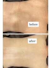 ビー ブルーム(B BLOOM)/【ハーブピーリング】BODYにも★