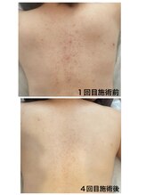 トゥモロー(TOMORROW)/ハーブピーリング/肌質改善