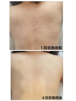 トゥモロー(TOMORROW)/ハーブピーリング/肌質改善