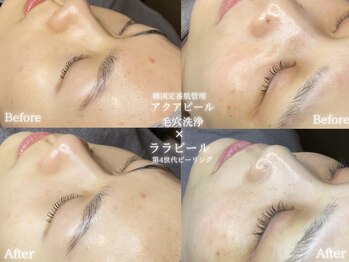 リル 和歌山市店(lilou)/大人気韓国肌管理