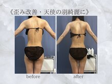 ジュプン 長崎/歪み改善で天使の羽綺麗に！