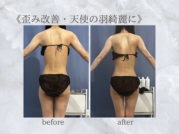 ジュプン 長崎/歪み改善で天使の羽綺麗に！