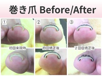 スロース鍼灸整体院(SLOTH鍼灸整体院)/巻き爪の改善例