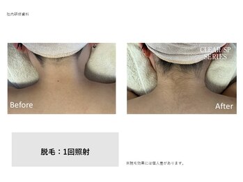 フェレザ 新潟(Felleza)/美肌光で肌質も改善します