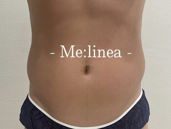 ミーリネア 南堀江(Me:linea)の写真/浮腫み撃退!圧倒的変化!気になる箇所だけを集中ケア!1箇所・2箇所と選べる♪筋肉引き締め&慢性的コリに◎
