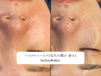 レオロ(leolo)/ピーリング&マイクロニードル