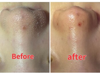 ビービー(BB)/#毛穴洗浄