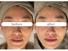 リスタ(RSTA)/【BEFORE/AFTER】