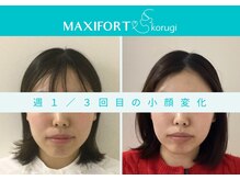コルギ専門店 マキシフォート 栄店(Maxifort)/週1 / 3回目での小顔変化