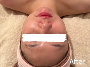 ダイヤモンド リーエンダ(Diamond leende)/クレイハーブピーリング