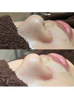 エクラ バイ シャンリィ(eclat by shanLy)/毛穴洗浄