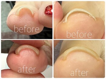 クランベリーネイル 所沢駅前店(cranberry nail)/フット巻爪ケア