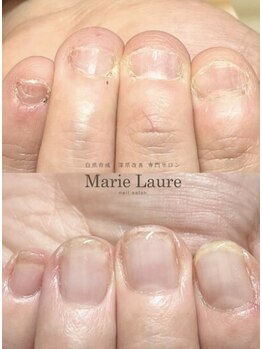 マリーロール 天王寺店(Marie Laure)/自爪育成/深爪矯正/ネイルケア