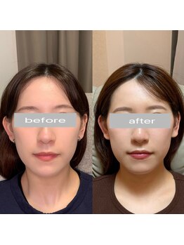 ナビレラ(navillera)/5回の施術《余白・顔の長さ縮小