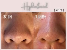 美シェリ(美Cheri)/ハイドラビフォーアフター