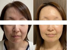 サクラ 伊勢原店(SAKURA)/極上プレミアムコースの1回体験