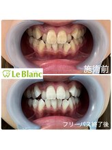 ルブラン 奈良店(Le Blanc)/歯にダメージを与えない！