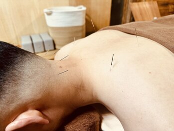 チルタイム(Chill Time)/鍼の施術