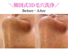 ダイヤモンド リーエンダ(Diamond leende)/韓国式3D毛穴洗浄