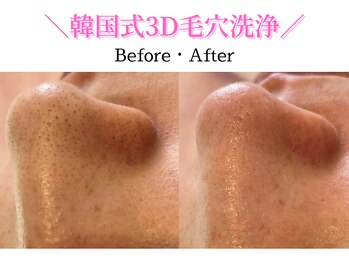 ダイヤモンド リーエンダ(Diamond leende)/韓国式3D毛穴洗浄