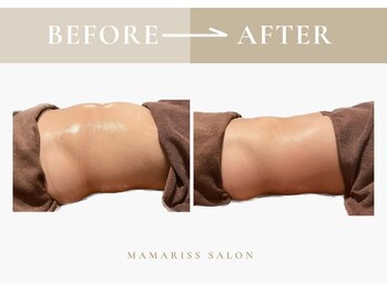 ママリスサロン(Mamariss Salon)/【痩身上半身 1回の施術効果】
