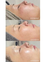 クレヴィー(Creviy)/ハーブピーリング4回経過