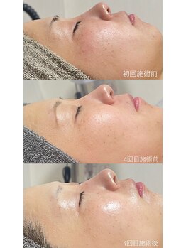 クレヴィー(Creviy)/ハーブピーリング4回経過