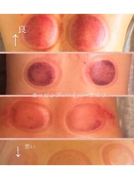 オーシャンブルーム 目黒(OceanBloom)/カッピング／ハイパーナイフ