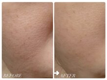 カピリナ(ka pilina)/★REVI炭酸ガスパック１回使用★