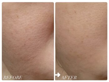 カピリナ(ka pilina)/★REVI炭酸ガスパック１回使用★