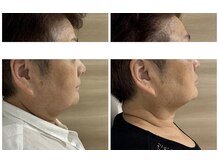 アロラヴィ(AroRavi)/レモンボトル＋たるみケア