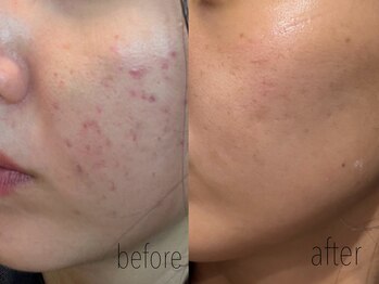 カノネ(Cannone')/ハーブピーリング / ニキビケア