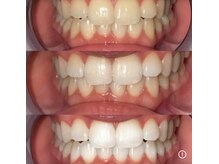 エクシアホワイトニング 代々木店/ホワイトニングビフォーアフター