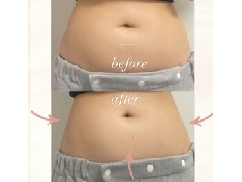 グラッソ(GRASSO)/マイクロウェーブボディ/痩身