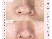 ルリエベル(Relier Belle)/肌荒れにはハーブピーリング