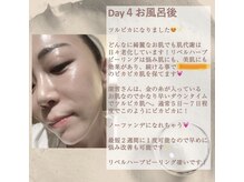 ノーブル 新宿南口(NOBLE)/ダウンタイムの様子