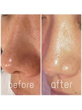 サラモ(Sa La Mo)/毛穴ケア＆毛穴洗浄+黒ずみ毛穴