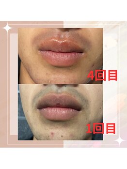 アットウィル 志木店(at will)/メンズひげ脱毛☆